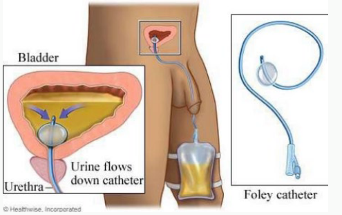 <p><strong>Indwelling Catheter</strong></p><p>-Also called a _____ catheter</p><p>-Goes in through the _______. A tiny ________ filled with water keeps one end inside the bladder. The other end ______ out into a bag that is either strapped to the leg or hanging from the side of a bed or a stand. </p><p>-An indwelling catheter needs to be replaced at least every _ month</p>
