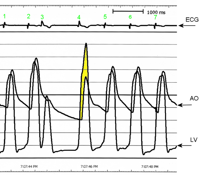 <p>Brockenbrough phenomenon</p><p><strong>Paradoxical Drop in Arterial Pulse Pressure:</strong></p><ul><li><p>Instead of generating a strong post-PVC pulse (which happens in normal hearts), the LVOT obstruction <strong>blocks blood flow</strong>, leading to:</p><ul><li><p><strong>Higher LV pressure</strong> (because blood is retained due to the obstruction).</p></li><li><p><strong>Lower aortic pressure</strong> (because less blood is ejected).</p></li></ul></li><li><p>This results in a <strong>decreased pulse pressure (lower SBP) after the PVC</strong>.</p></li></ul><p><strong>more volume leads to greater obstruction</strong> due to the hypertrophied septum and systolic anterior motion (SAM) of the mitral valve</p>