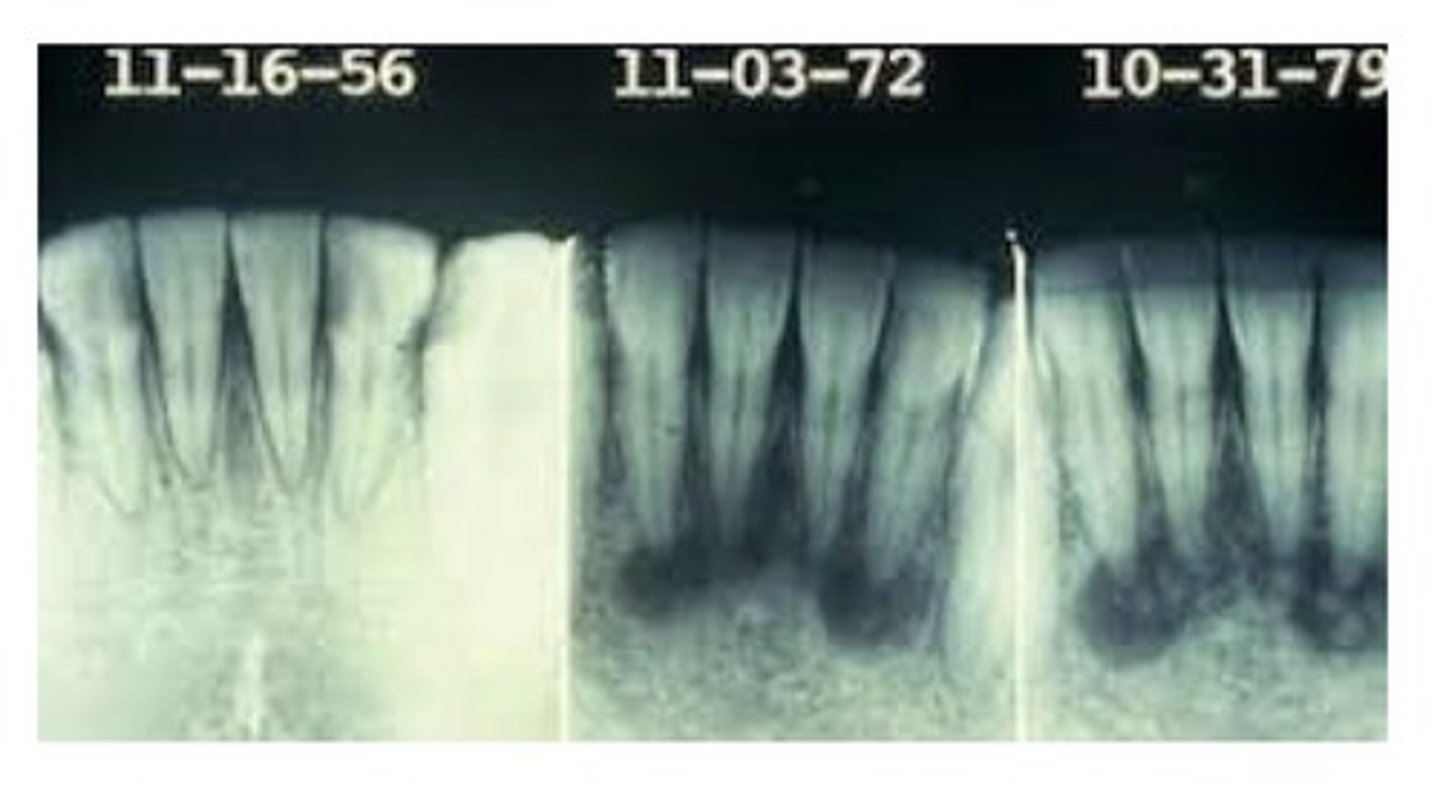 <p>A relatively common disease of unknown cause that affects periapical bone. Occurs most commonly in the anterior mandible of patients older than 30. More common in women than men- hormonal link. Early lesions are well circumscribed and radiolucent; with time, they becomes increasingly calcified. Teeth in the affected area are vital.</p>