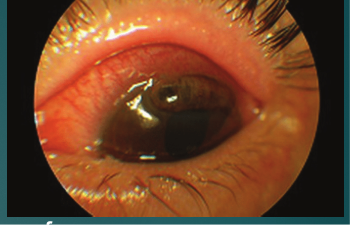 <p>Thinning of the cornea and eventual perforation of cornea may result in endophthalmitis and loss of eye</p>