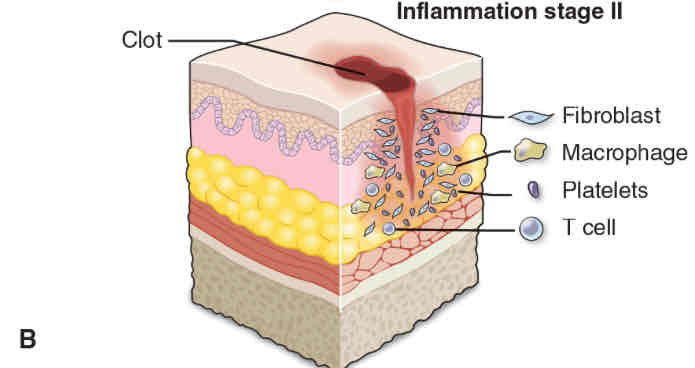 <p>WBCs clear debris and fight infection</p><p>Vasodilation, increased vascular permeability, & chemotaxis</p><p>5 Cardinal Signs of Inflammation</p><ul><li><p>Redness (Rubor)</p></li><li><p>Heat (Calor)</p></li><li><p>Swelling (Tumor)</p></li><li><p>Pain (Dolor)</p></li><li><p>Loss of function (Functio laesa)</p></li></ul><p>(Should review acute and chronic inflammation later)</p>