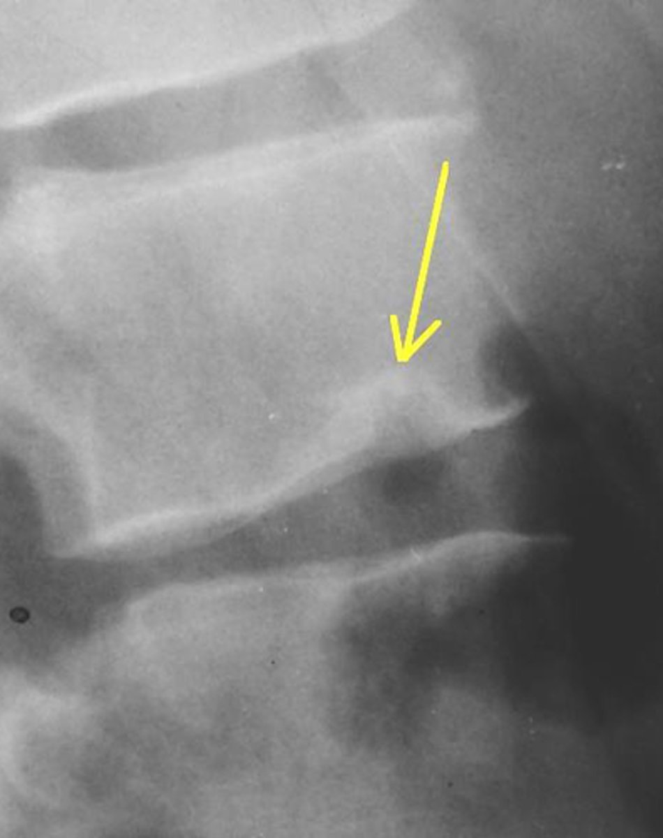 <p>Scheuermann disease → schmorl nodes</p>