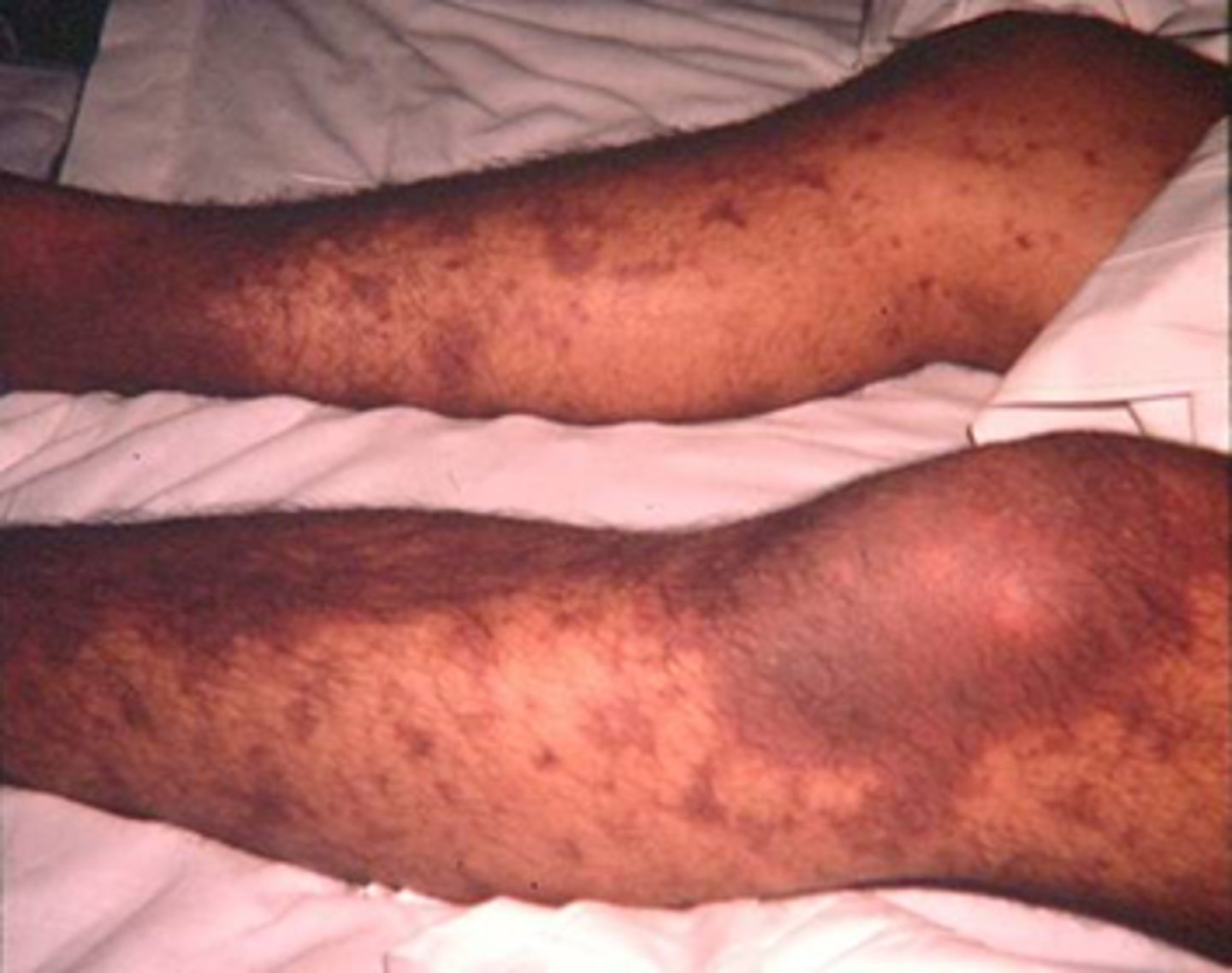 <p>- activation of coagulation via tissue injury</p><p>- stimulates endothelial cells, platelets, inflammatory mediators</p><p>- decreased hepatic perfusion due to shock => decreased plasmin for clot lysis &amp; decreased coagulation factor formation</p>