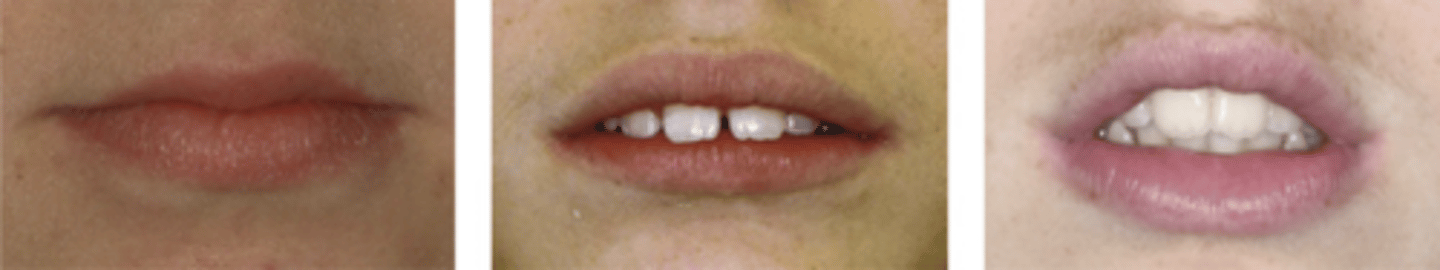 <p>apart at rest</p><p>require excessive muscular activity to obtain lip seal</p>