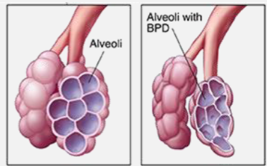 <ul><li><p>damaged lung tissue</p></li><li><p>slightly collapsed alveoli</p></li></ul><p></p>