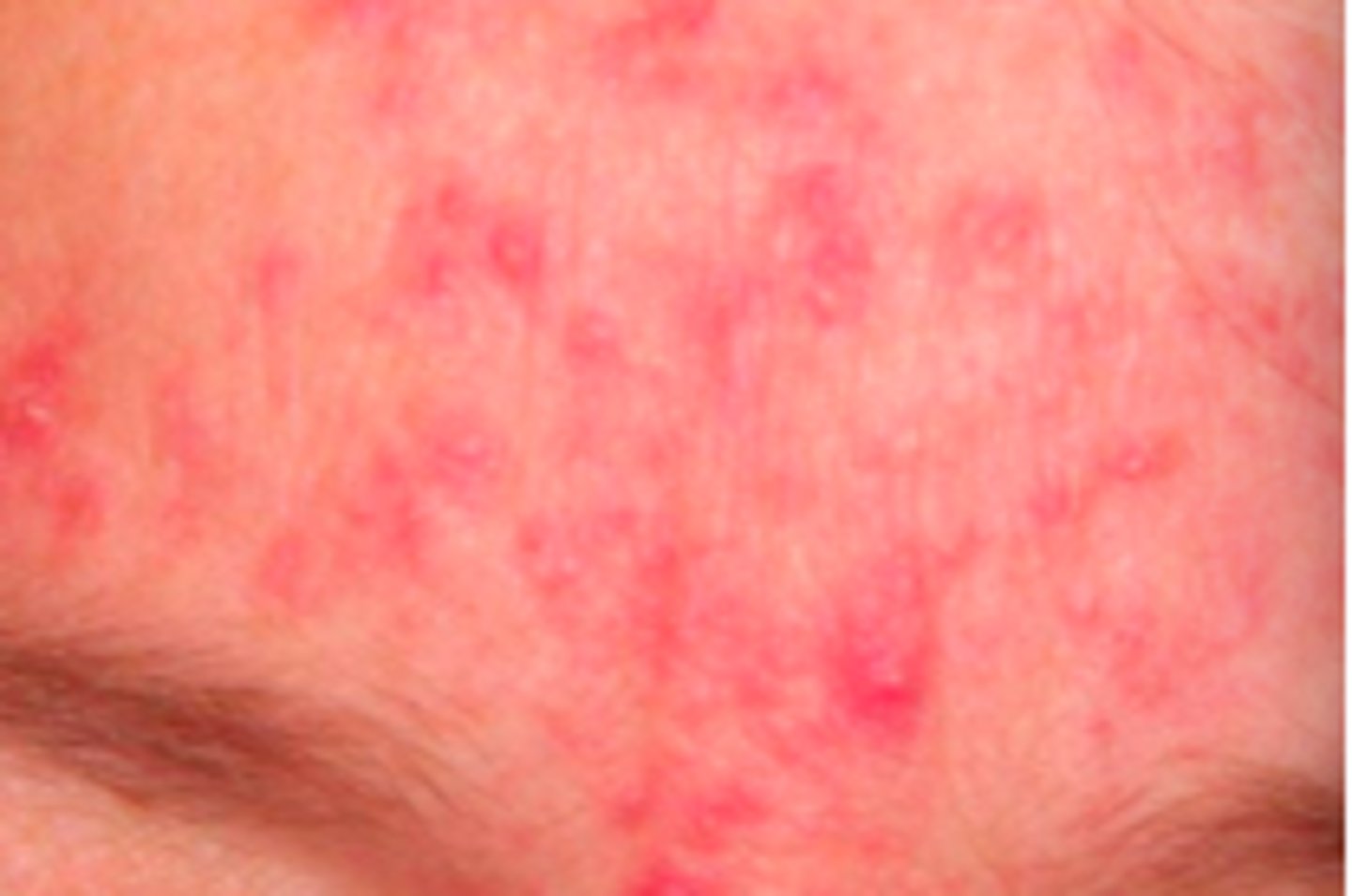 <p>Acneiform Disorders:</p><p>Subjective:</p><p>Facial flushing precipitated by triggers</p><p>Clinical signs:</p><p>- Erythema, telangiectasia, coarseness/grittiness of skin, inflammatory papulopustular eruption resembling acne</p><p>- Intermittent symptoms at first but can lead to permanence</p>