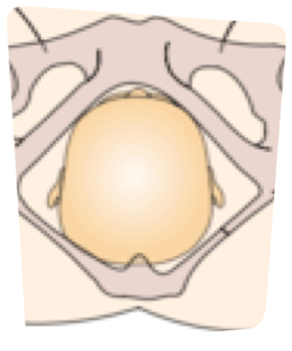 <p>Most common</p><p>OP position often causes low back pain for women in labor</p><p>Longer duration of labor</p>