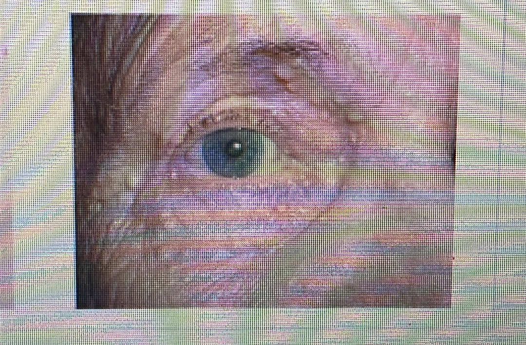 <p>GLAND DISORDER</p><p><span style="font-family: Calibri, sans-serif"><strong>Sebaceous hyperplasia: A skin condition common in people who are older that causes small, yellowish bumps on your skin.</strong></span></p>