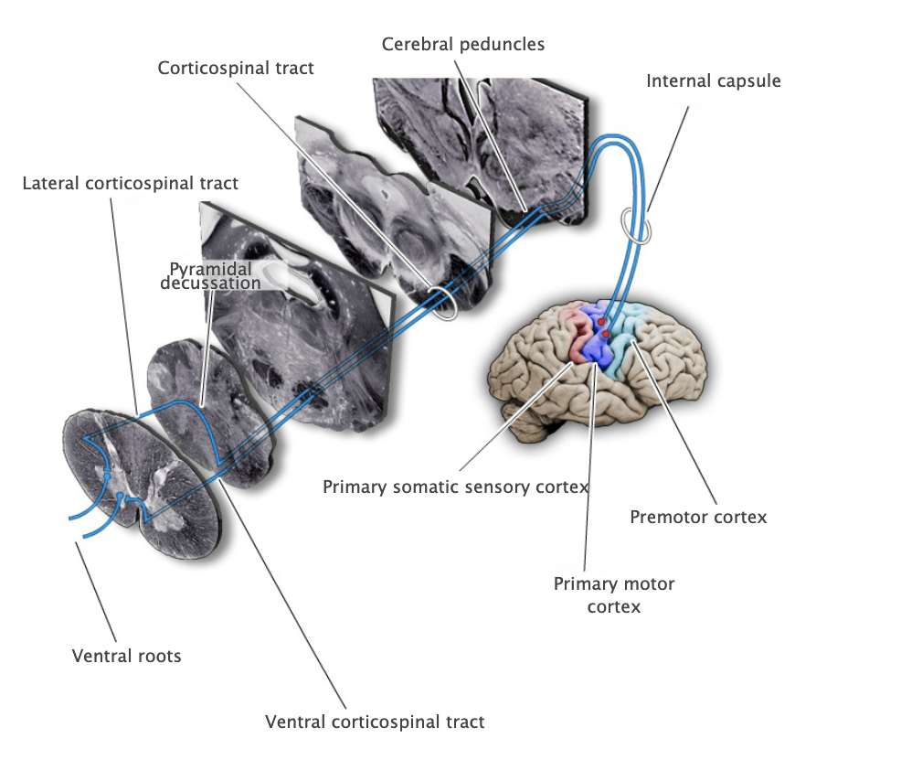 <p>Decussating component (about 90% of total) of the corticospinal projection that originates in the motor cortical areas of the posterior frontal lobe and the postcentral gyrus. The lateral corticospinal tract is located in the lateral white column of the spinal cord and terminates in the lateral portion of the ventral horn, where it governs the lower motor neuronal pools that control the distal extremities.</p>