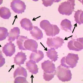 <ul><li><p>small red cells surrounded by uneven thorn-like spikes</p></li><li><p>found in those with liver disease, autoimmune hemolytic anemia, and LCAT deficiency</p></li></ul><p></p>