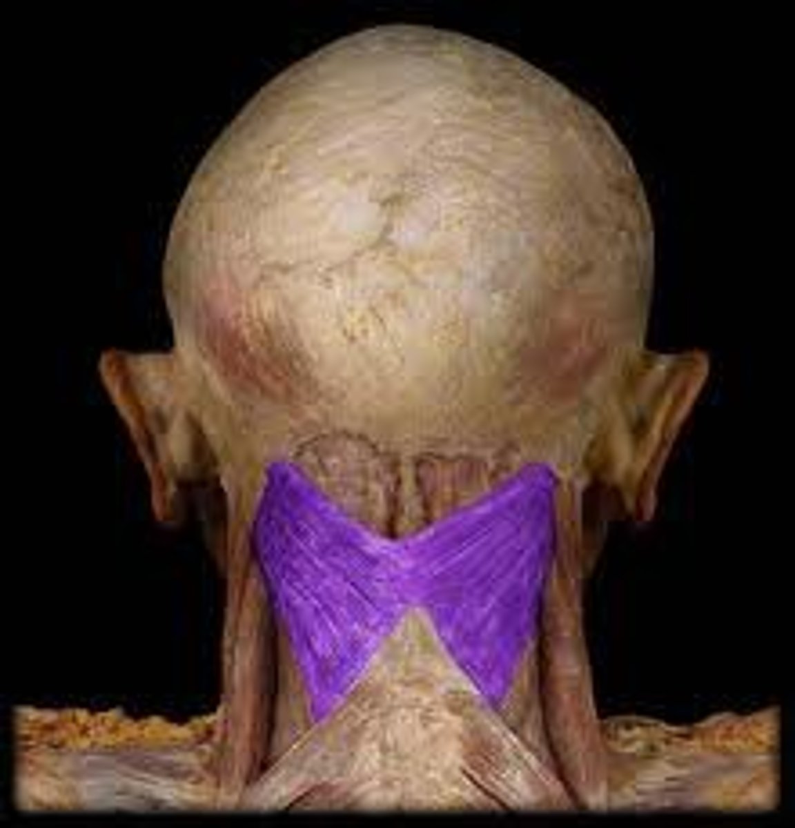 <p>Origin: Inferior half of nuchal ligament, spinous processes of vertebrae C7-T6</p><p>Insertion: occipital bone; temporal bone</p><p>Action: Acting unilaterally, produce ipsilateral flexion and slight rotation of head; extend head when acting bilaterally</p>
