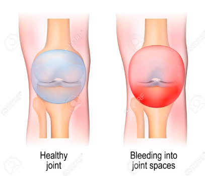 <p>Acumulación de sangre extravasada en la cavidad de una articulación.</p>