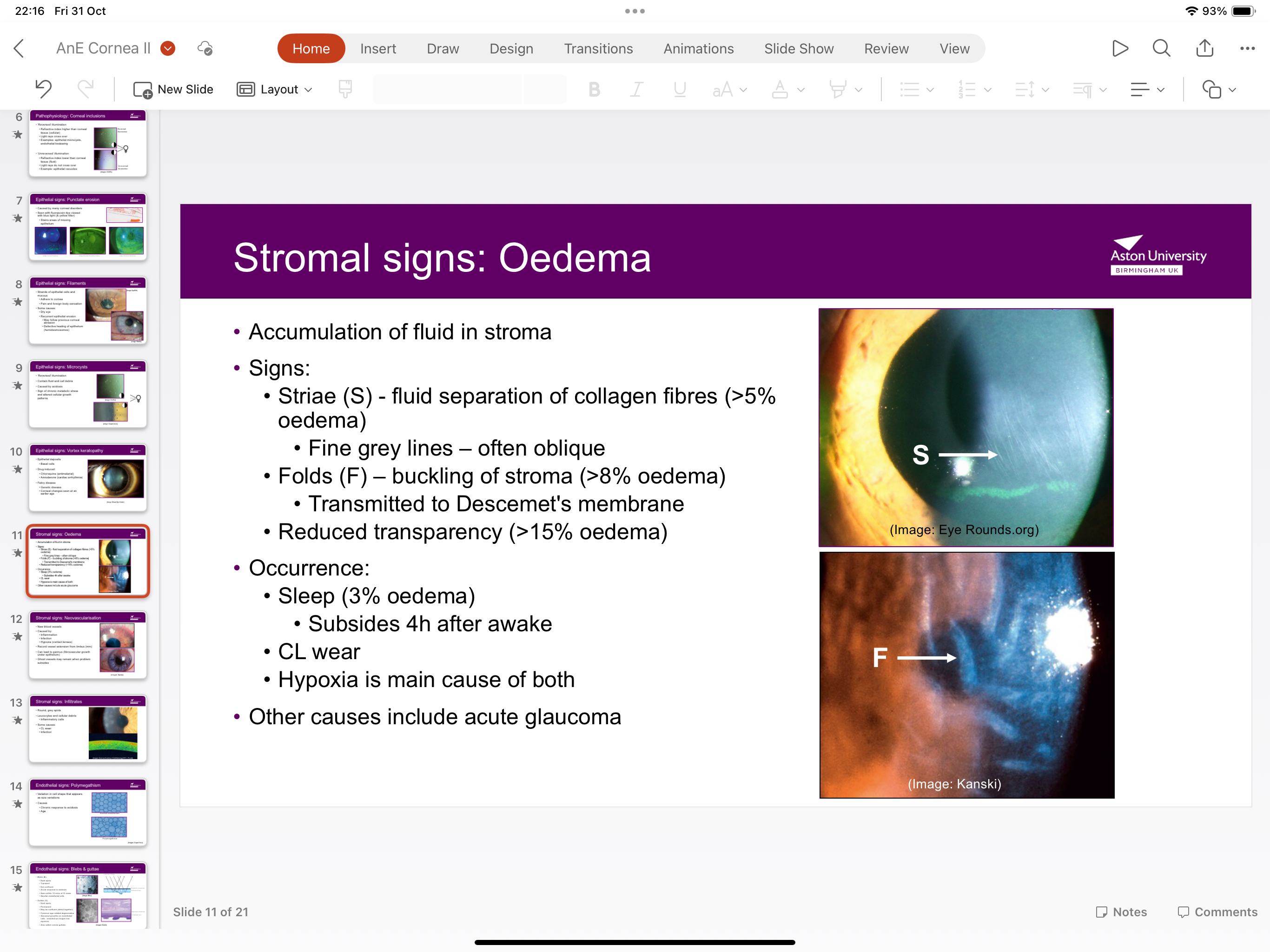 <p>Accumulation of fluid in the stroma</p>