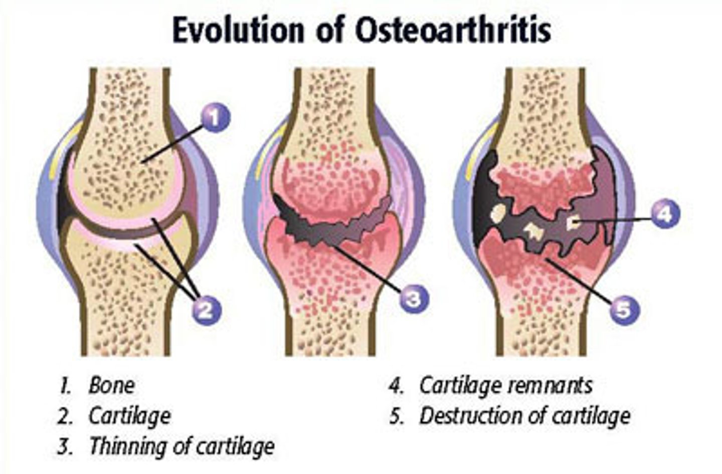 <p>What degenerative joint disease causes the flaking of cartilage that exposes underlying bone, is generally non-inflammatory and produces bone spurs (osteophytes)</p>