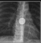 <p>You're on your ER clinical rotation when your preceptor pimps you: how can you tell the difference between a coin and a button battery in a person's airway from radiologic studies?</p>