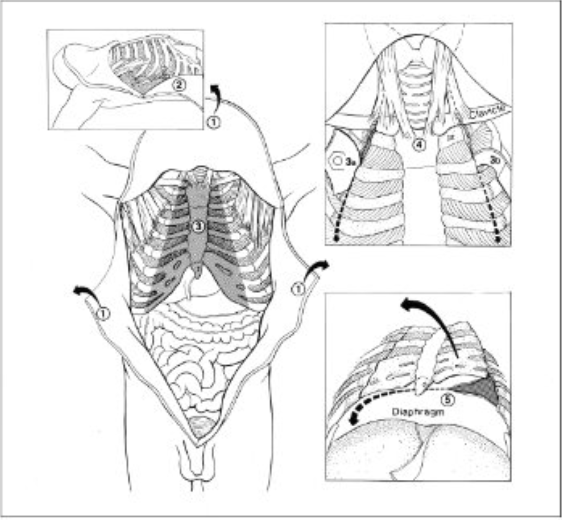 <ol><li><p>Reflect the skin flaps. Cut perpendicular to the ribcage. Make relaxing incisions in the peritoneum and musculature about 15cm above the symphysis</p></li><li><p>Check for tension pneumothorax. make a pool of water in the axilla. Push the closed clamp through an intercostal muscle beneath the water level.</p></li><li><p>Release the chest plate. Cut ribs medial to the costochondral junction and the clavicle lateral to the sternoclavicular joint with either: </p><p>-An oscillating saw; linoleum knife and bone shears; or pruning shears</p></li><li><p>Preserve the muscle attachments to the manubrium and head of the clavicle</p></li><li><p>Detach the diaphragm from the chest plate.</p></li></ol><p>Inspect surfaces and contents of the pleural spaces.</p>