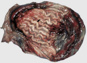 <p>What is this condition linked to azotaemia and explain its pathogenesis.</p>
