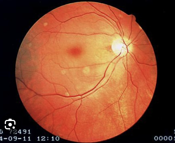 <p>46 y/o female presents to the ED for sudden left eye vision loss that started 30 minutes ago. She reports no pain. On physical exam you note a cherry red spot. What do you want to do?</p>