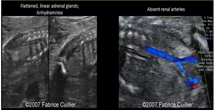 <p>which is assoc w/ oligohydramnios/anhydramnios</p><p>.</p><p>a) chorioangioma</p><p>b) duodenal atresia</p><p>c) potter syndrome</p><p>d) twins</p>
