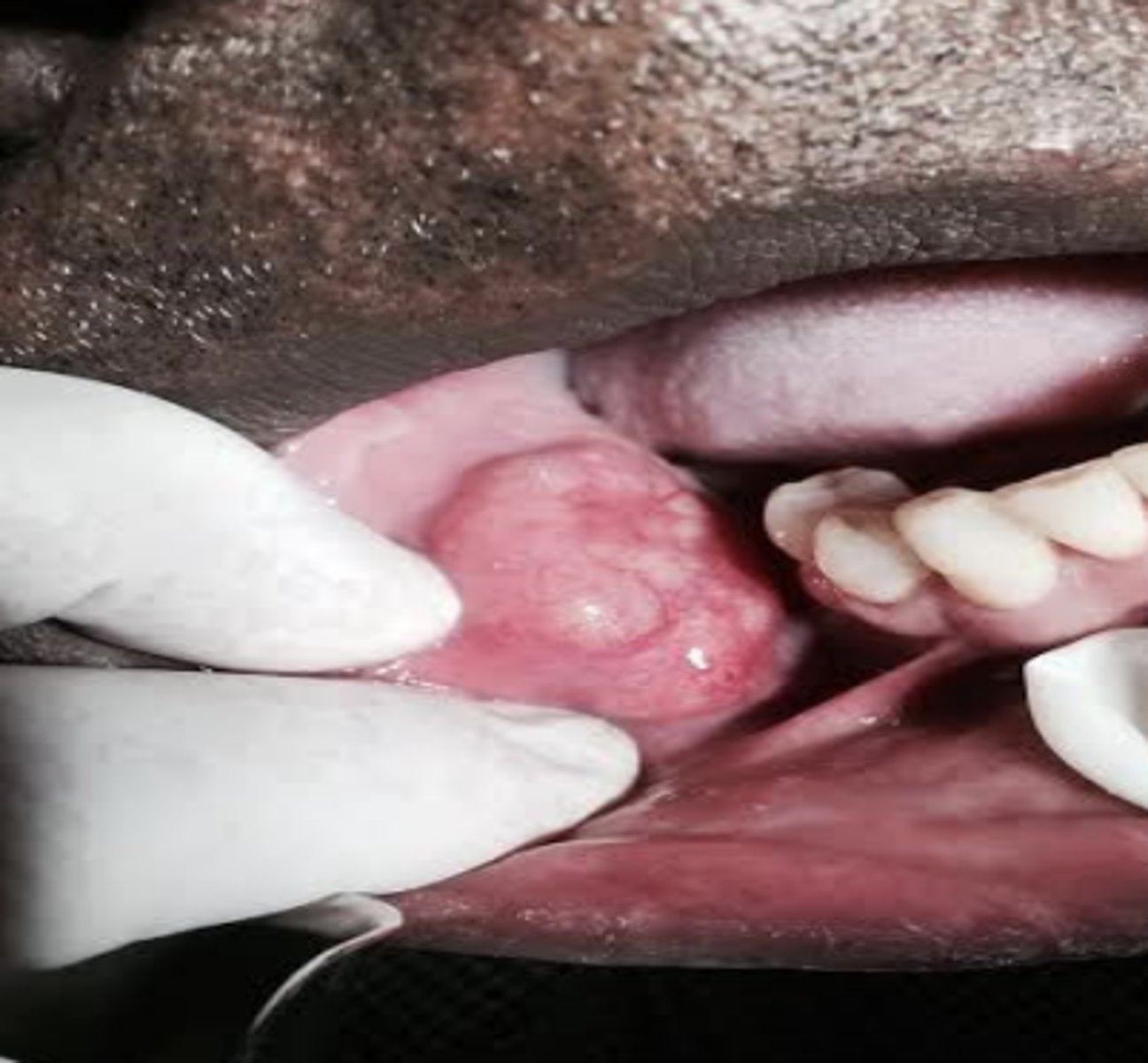 <p>Adenoid cystic carcinoma</p>