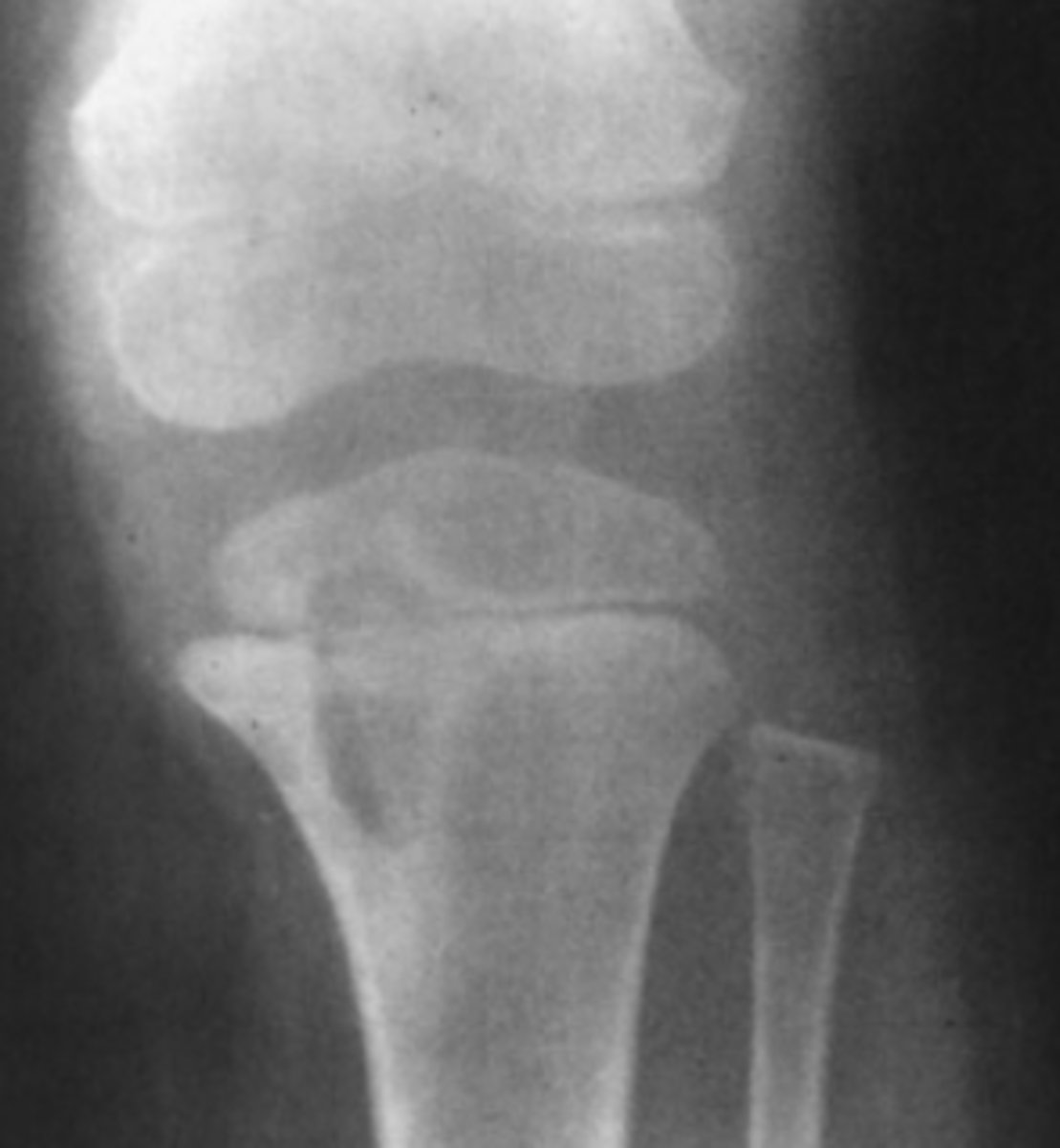<p>What is the most likely diagnosis for Case 6-7</p><p>(Figure 6-20)?</p><p>A. Osteomyelitis</p><p>B. A malignant bone tumor</p><p>C. A Salter-Harris IV fracture</p><p>D. Langerhans cell histiocytosis</p>