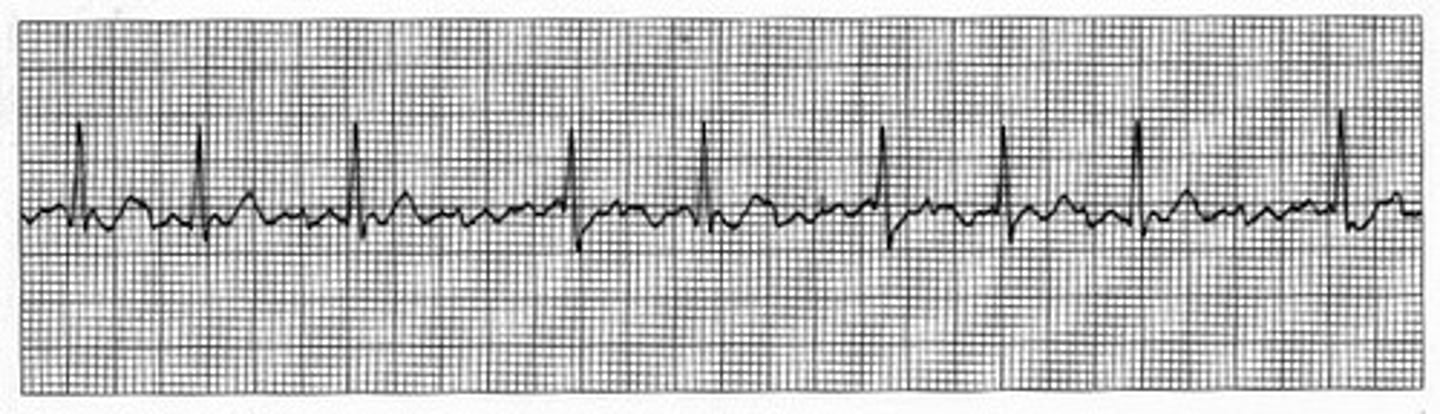 <p>Multiple ectopic areas in the atria fire causing random impulses to reach the ventricles resulting in an irregular rhythm.</p>
