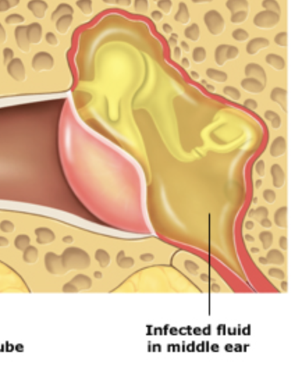 <p>happens when eustachian tube gets blocked, inflammation of the middle ear</p>