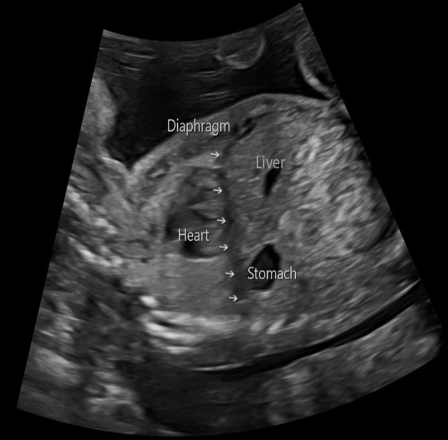 <p>which imaging plane will best display the fetal diaphragm</p><p>a) sagittal</p><p>b) coronal</p><p>c) transverse</p><p>d) transverse oblique</p>