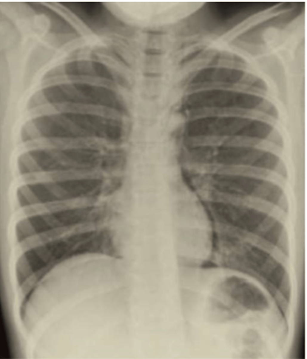 <p>Identify this complication of N/V:</p><p>Trans-mucosal tear with perforation</p><p>**CATASTROPHIC**</p><p>-PE:</p><p>&gt; Subcutaneous crepitus</p><p>&gt; Emphysema</p><p>-Dx: (CXR)</p><p>&gt; Free air in mediastinum</p>