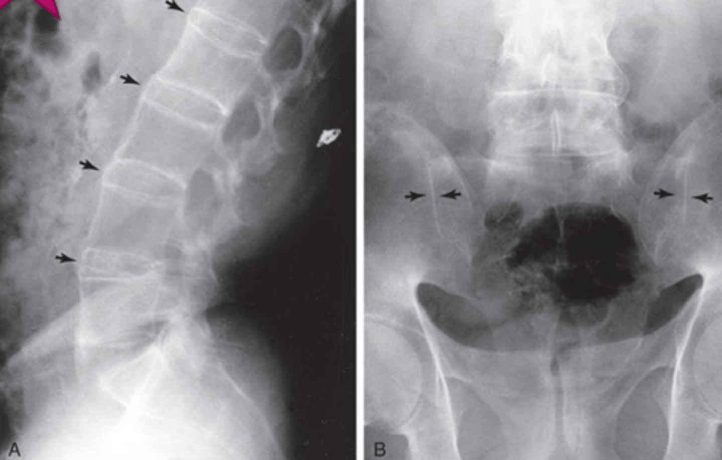 <p>What pathology is seen here?</p>