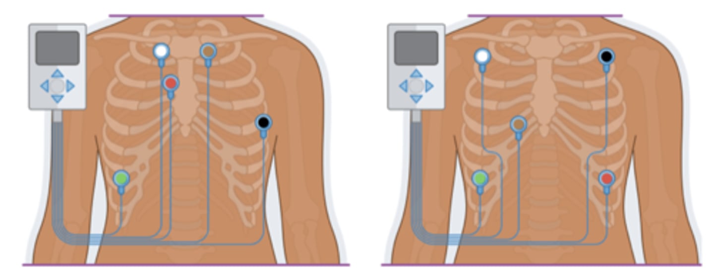 <p>Portable battery-operated device that continuously monitors ♡ activity ≥24hr; AKA ambulatory monitor</p>