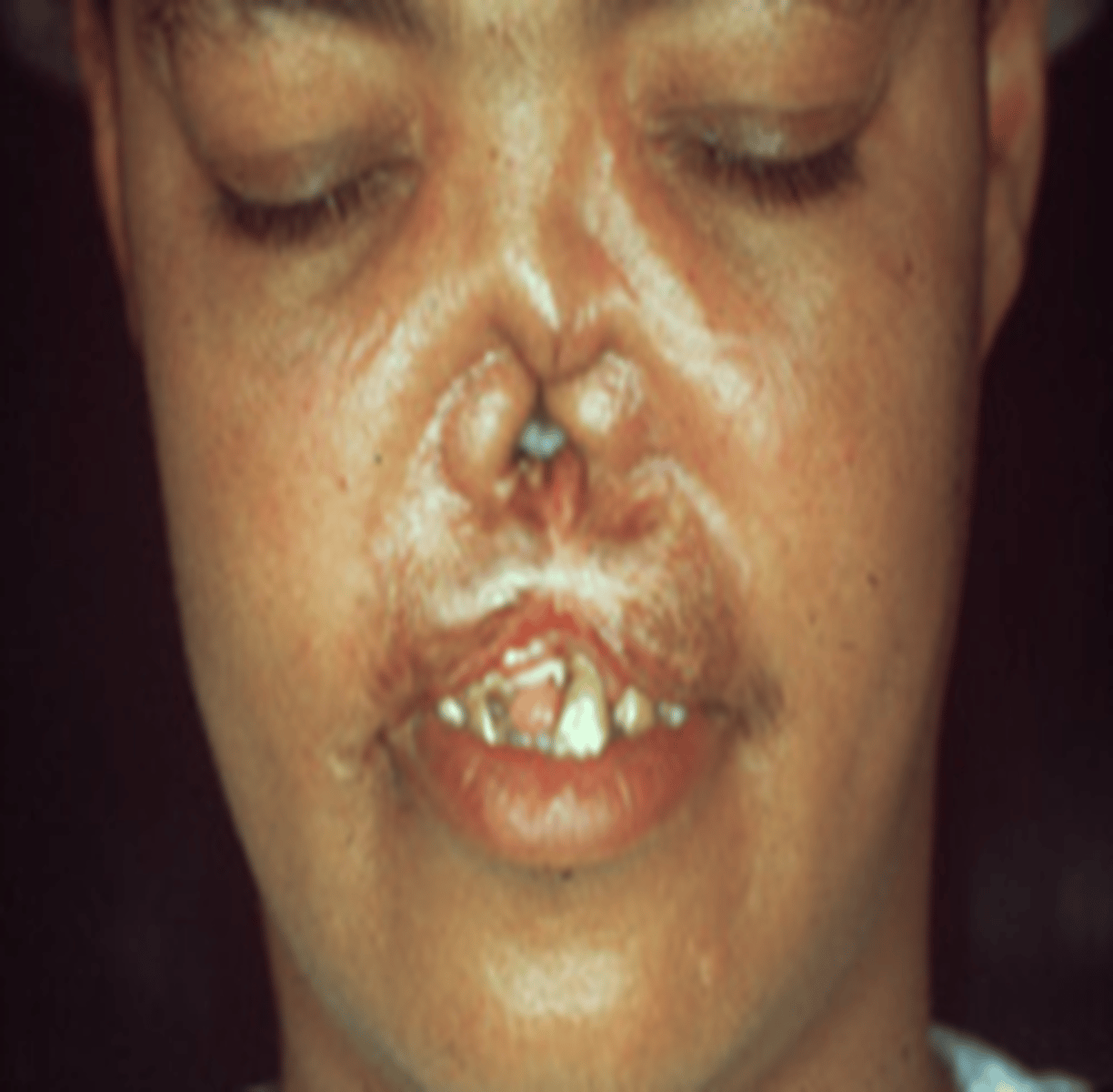 <p>ÒNearly half of all children infected with syphilis while they are in the womb die shortly before or after birth.</p><p>ÒNo bridge to nose (saddle nose)</p>