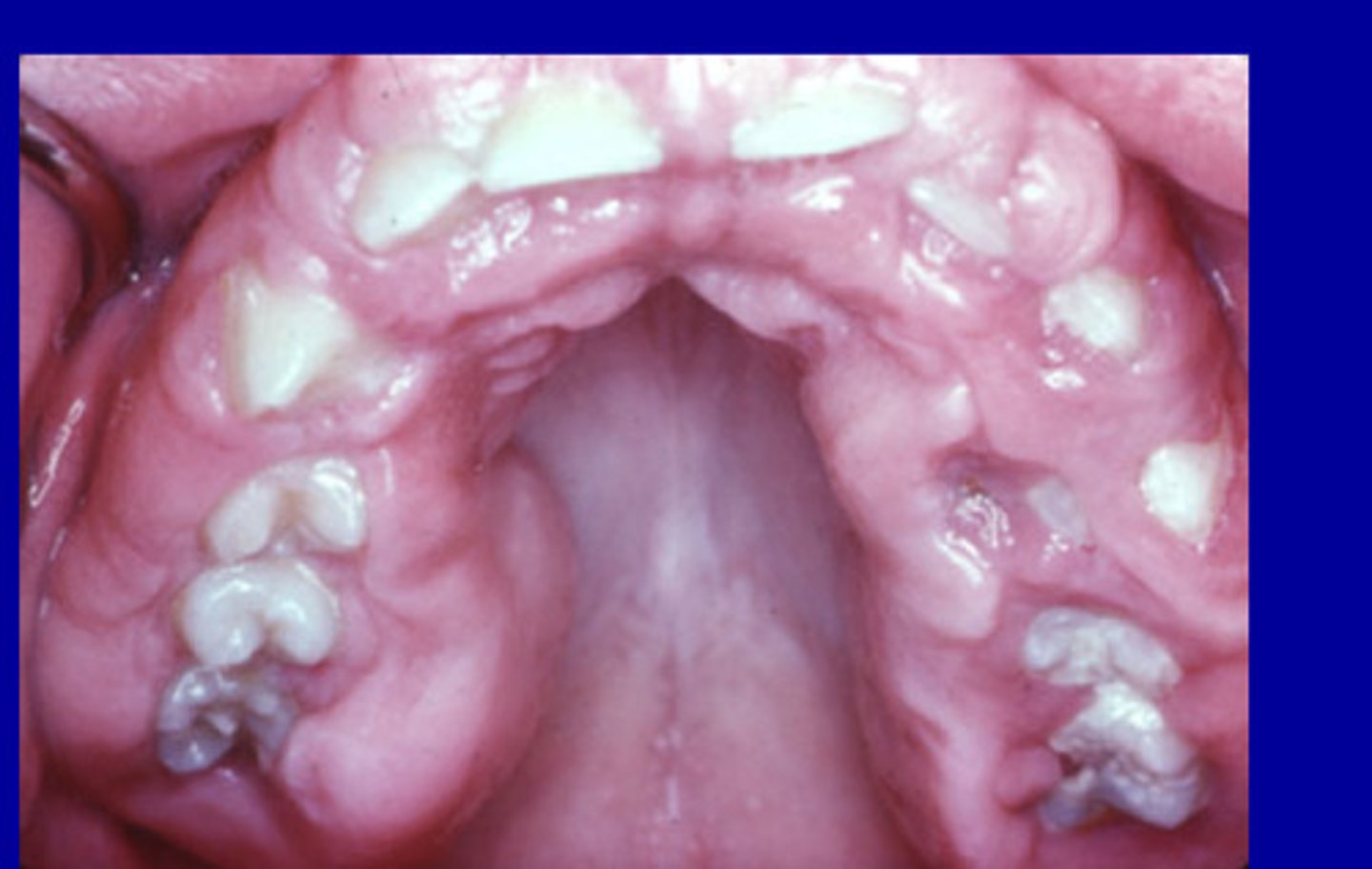 <p>rare benign oral condition characterized by slow and progressive enlargement of both maxillary and mandibular attached gingiva</p>
