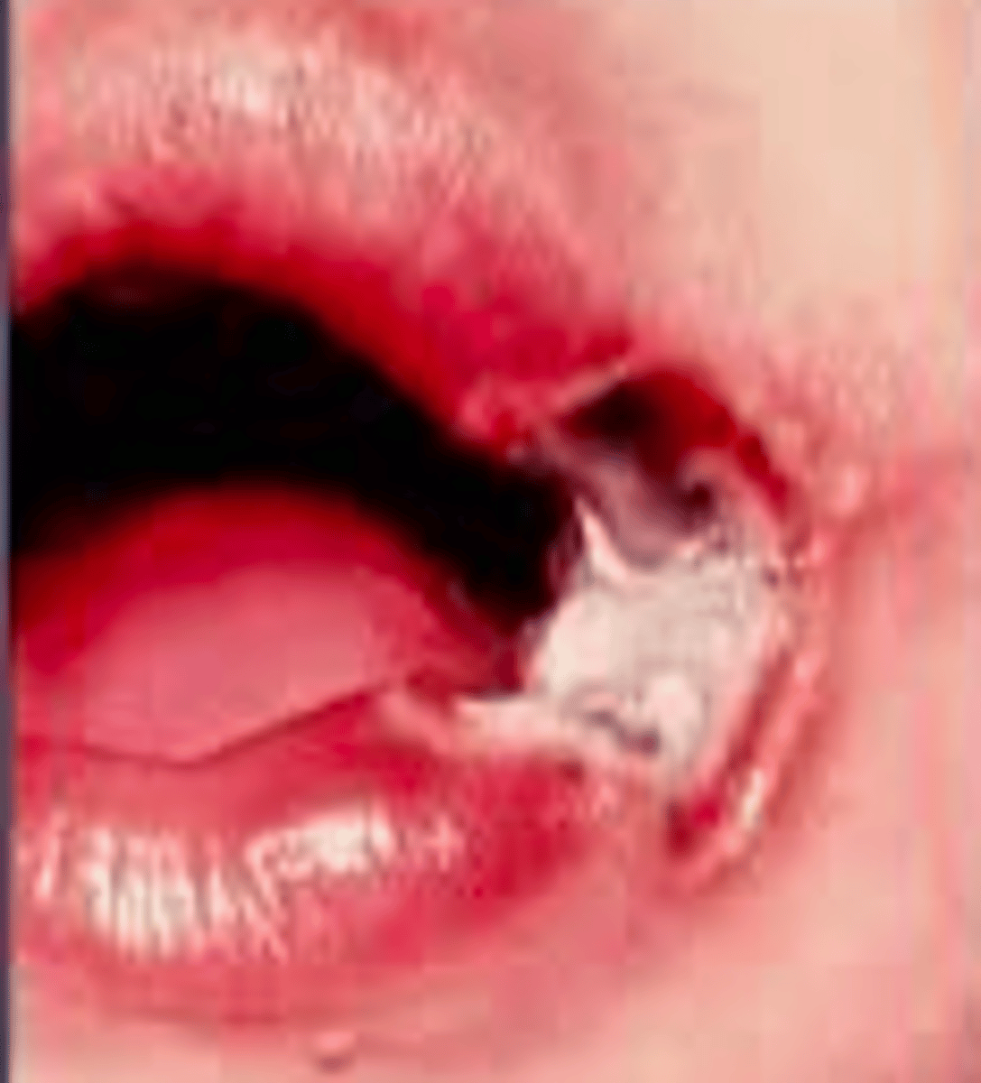 <p>necrosis of tissues - including tooth buds</p><p>• population: children</p>