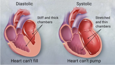 <p>Progressive and often fatal mortality resulting from decreased cardiac output and tissue perfusion and increased fluid retention (peripheral edema/SOB/exercise intolerance)&nbsp;</p><ul><li><p>Caused by heart attack, high (chronic) BP</p><ul><li><p>After load high = hypertrophy</p></li></ul></li><li><p>Diastolic (preserved EF) HFpEF (HF with perserved EF) </p><ul><li><p>Stiff and thick chambers</p></li><li><p>Heart can’t fill, not a lot of blood goes out with contraction </p></li><li><p>Stronger LV - pump to whole body&nbsp;</p></li><li><p>Hypertrophy (can’t fill properly) = due to tachycardia, high BP, obesity (increased after load due to more peripheral vascular resistance)&nbsp;</p></li></ul></li><li><p>Systolic (reduced EF) HFrEF (HF with reduced EF) </p><ul><li><p>Stretched and thin chambers&nbsp;</p></li><li><p>Heart can’t pump&nbsp;(not strong enough) </p></li><li><p>Severe heart attack (damage to myocytes) = weak heart muscle&nbsp;</p></li><li><p>Have blood in ventricle, just can’t squeeze it out </p></li></ul></li><li><p>Can be right sided, left sided, or both!</p><ul><li><p>Diastolic-systolic HF&nbsp;(whole heart)</p></li></ul></li></ul><p></p>