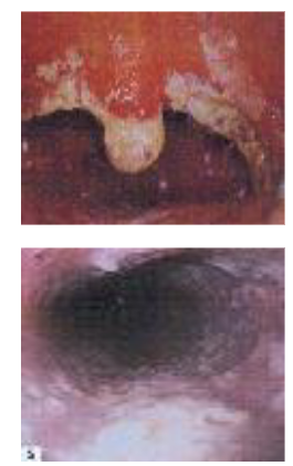 <p>A 24 years old female partner of an IVDU presents with weight loss, pain on swallowing (odynophagia), and nausea</p><p>Superficial, raised white plaques on mucosal surface of esophagus viewed through endoscope.</p><p>Patient found to have HIV infection and advanced AIDS at presentation</p>