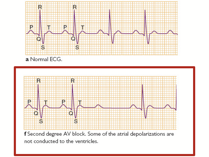 <p>A condition where signals between atria and ventricles can intermittently fail to conduct. Example: the QRS wave for ventricular contraction is missing (some of the atrial depolarizations are not conducted to the ventricles).</p>