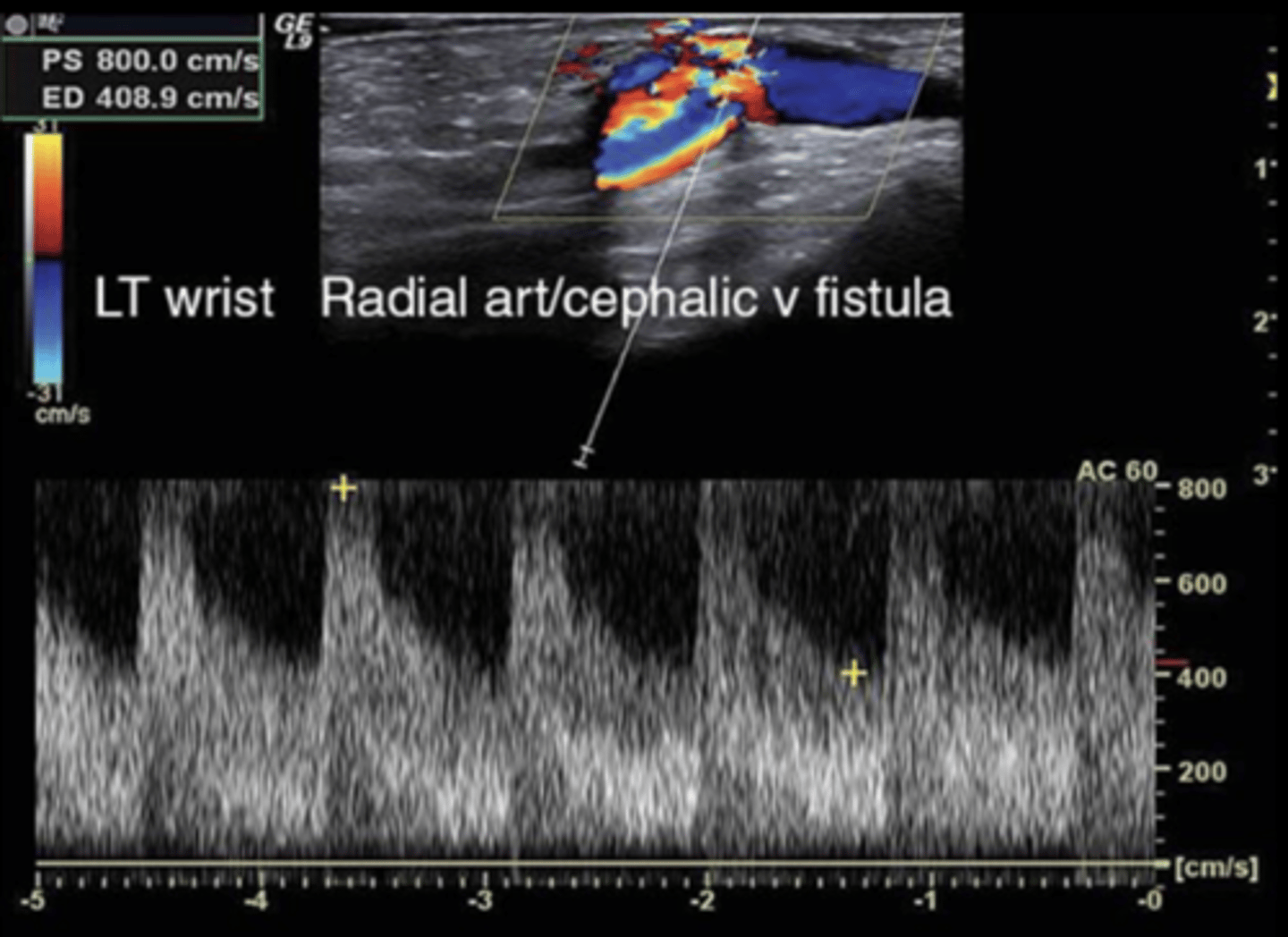<p>1 cm below skin</p><p>Low resistant - forward diastolic flow &amp; spectral broadening</p><p>Elevated PSV &amp; EDV velocities</p>
