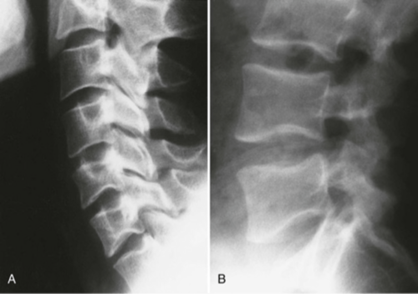 <p>In an AP radiograph, what sign can you expect to see with this diagnosis?</p>
