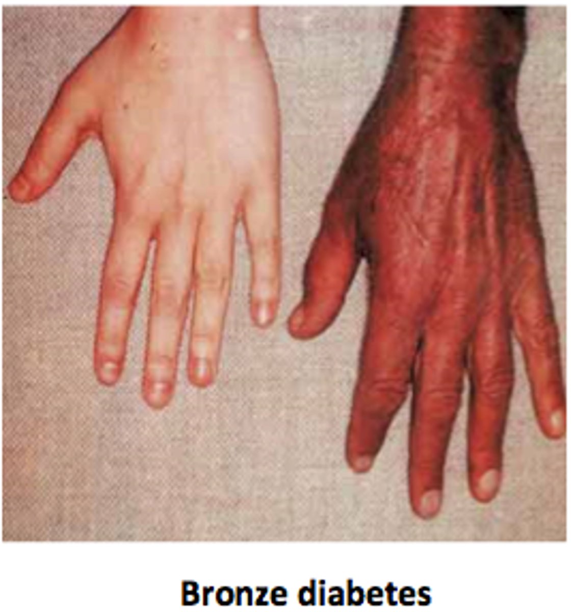 <p>diagnose this:</p><p>Abnormal pigmentation; Slate gray from iron plus brown melanin in skin -> bronze color of skin</p>