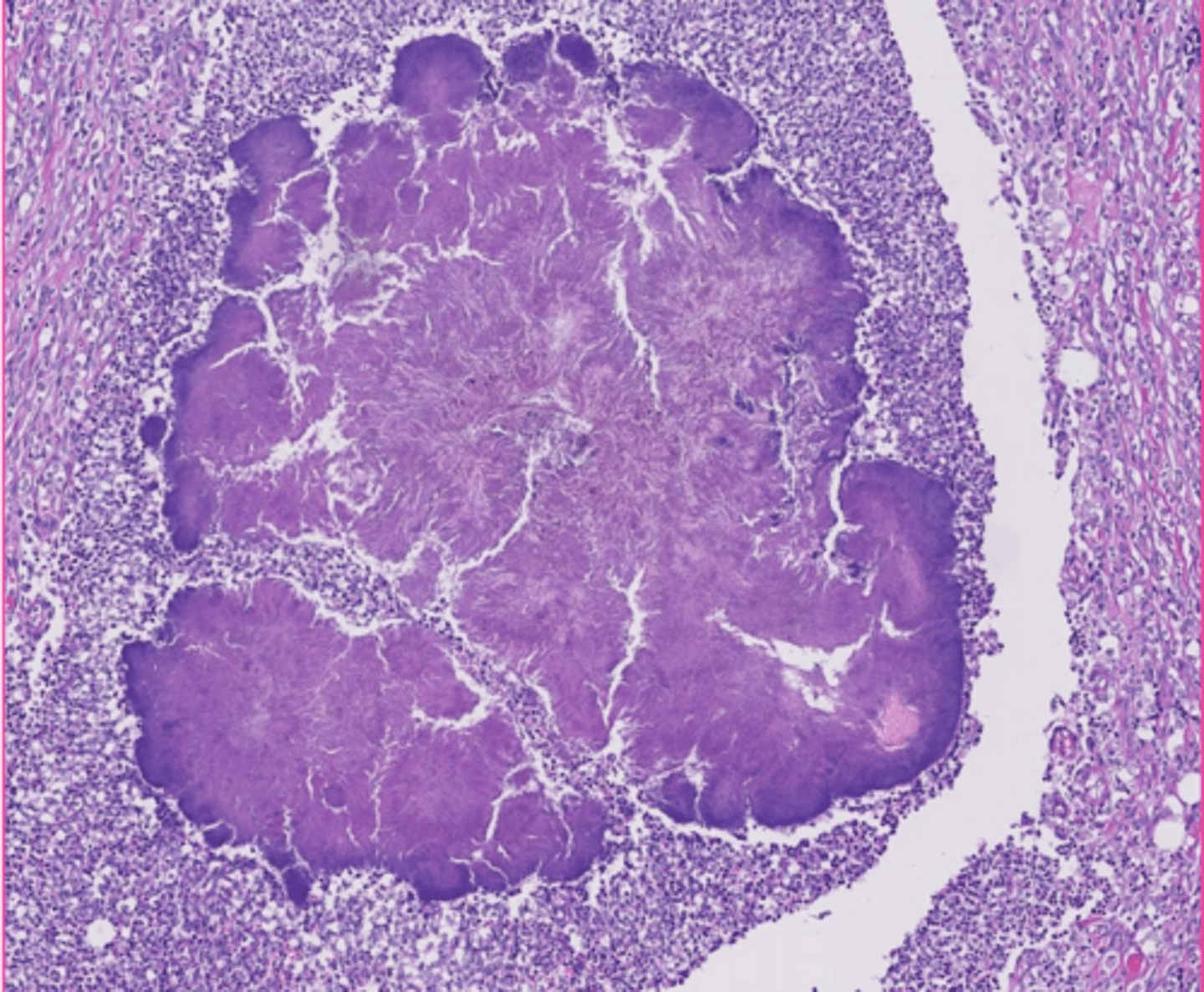 <p>this is actually a caseous necrosis, but how would you describe the extracellular accumulations?</p>