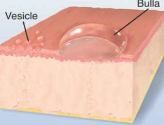 <p>larger than 1cm, usually single chamber, superficial in dermis &amp; ruptures easily</p>