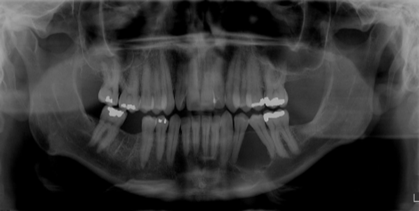 <p>ID the cyst:</p><p>- Radiolucent lesion</p><p>- Well defined corticated periphery</p><p>- Round/oval</p><p>- Located between cervical margin &amp; apex of adjacent vital teeth</p><p>- Typically in contact with root surface</p>