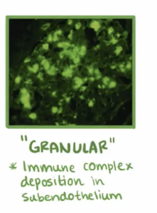 <p>Nombre de glomerulonefritis rapidamente progresiva</p>