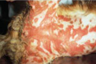 <p>Síndrome en respuesta a un antígeno, puede ser medicamento, infección o neoplasia. </p><p>Hipersensibilidad asociada a linfocitos T que produce apoptosis en los queratinocitos. </p><p>Lesiones principales son: eritema, máculas, collaretes, pápulas circulares y placas</p>