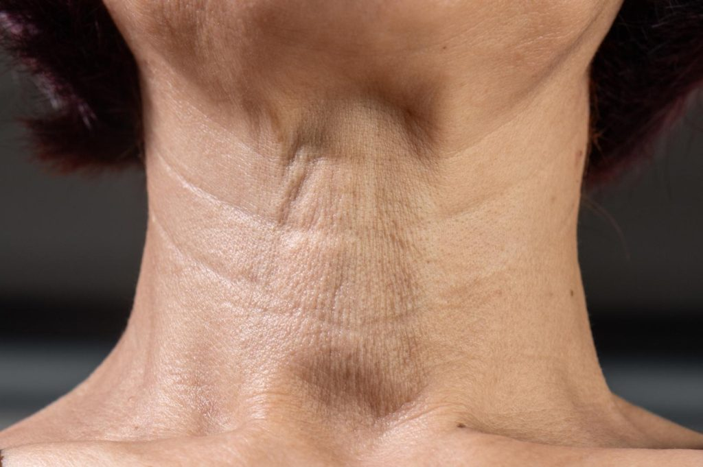 <p>Platysmal sulci</p>