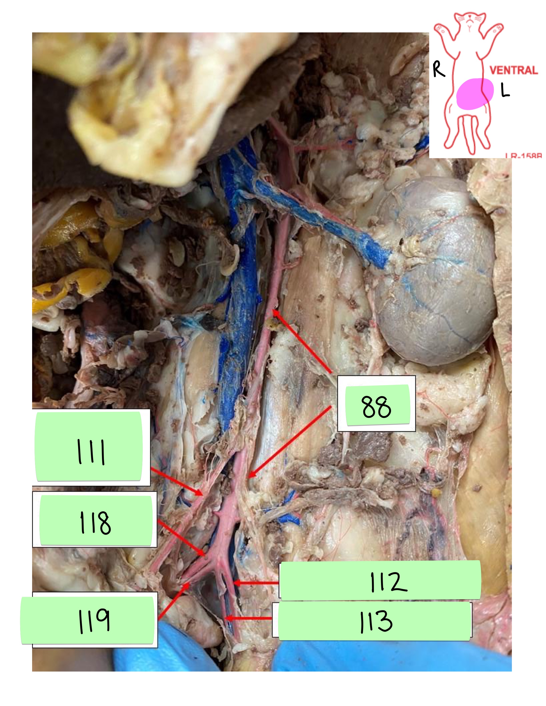 <p>right external iliac artery</p>