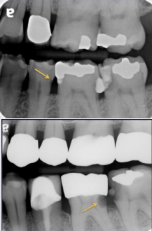 <p>saucer like irregular cavitation </p>