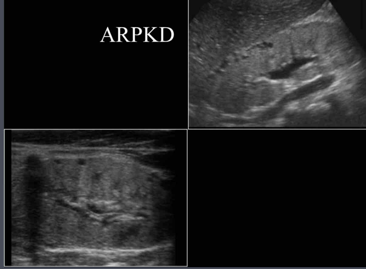 <p>What is the sonographic appearance of ARPKD? </p>