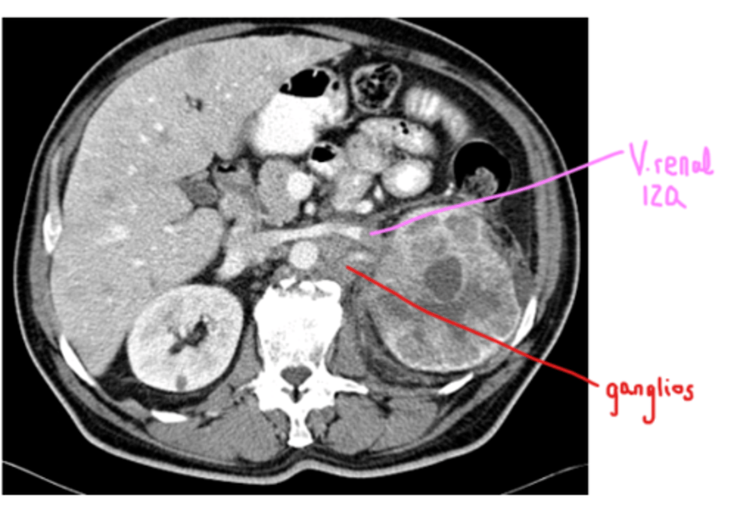 <p>Ganglios aumentados de tamaño alrededor de la aorta, con densidad tumoral.</p>